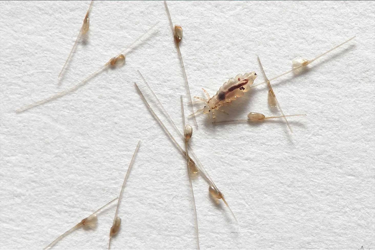 How Lice Live – Understanding Head Lice can help - Lice Clinics of America